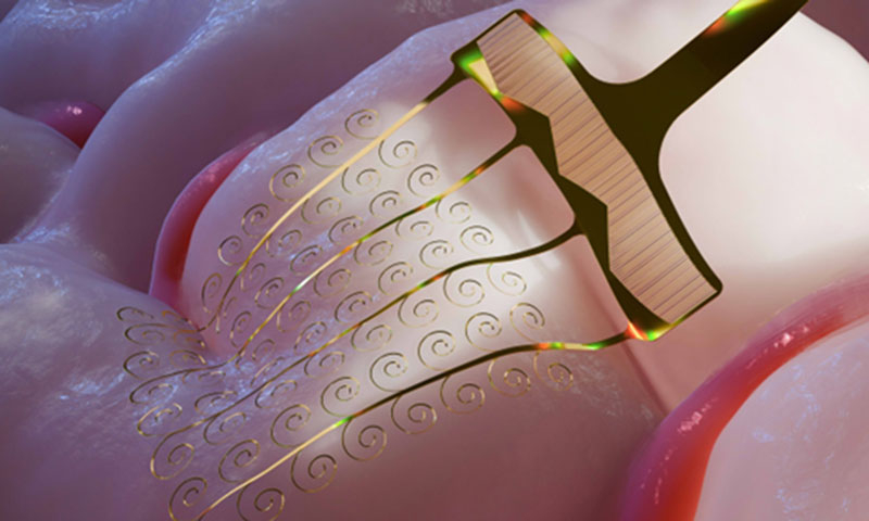 China has developed the world's best electrodes for brain implants—they do not damage the brain, unlike Neuralink.